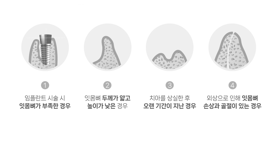 골이식이 필요한 경우